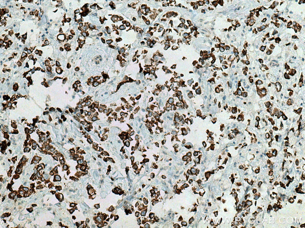 Immunohistochemistry (IHC) staining of human breast cancer tissue using PRODH Polyclonal antibody (22980-1-AP)