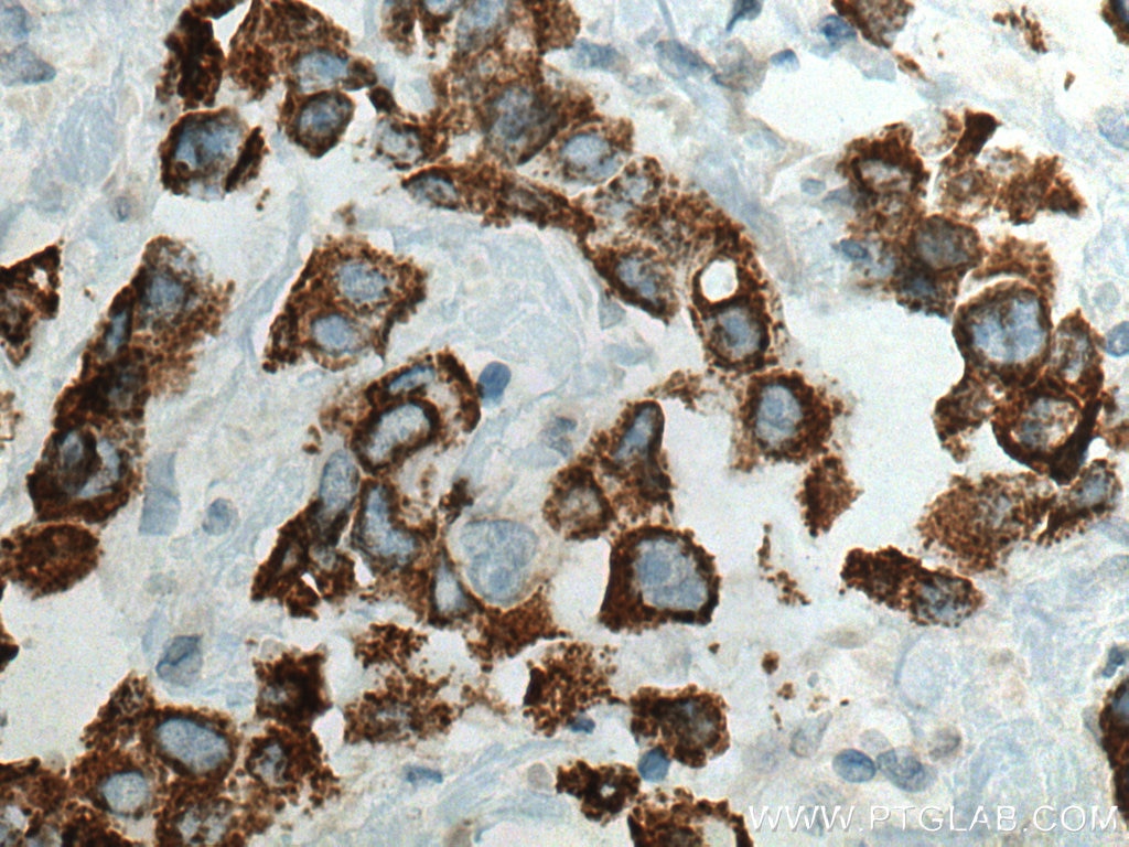Immunohistochemistry (IHC) staining of human breast cancer tissue using PRODH Polyclonal antibody (22980-1-AP)