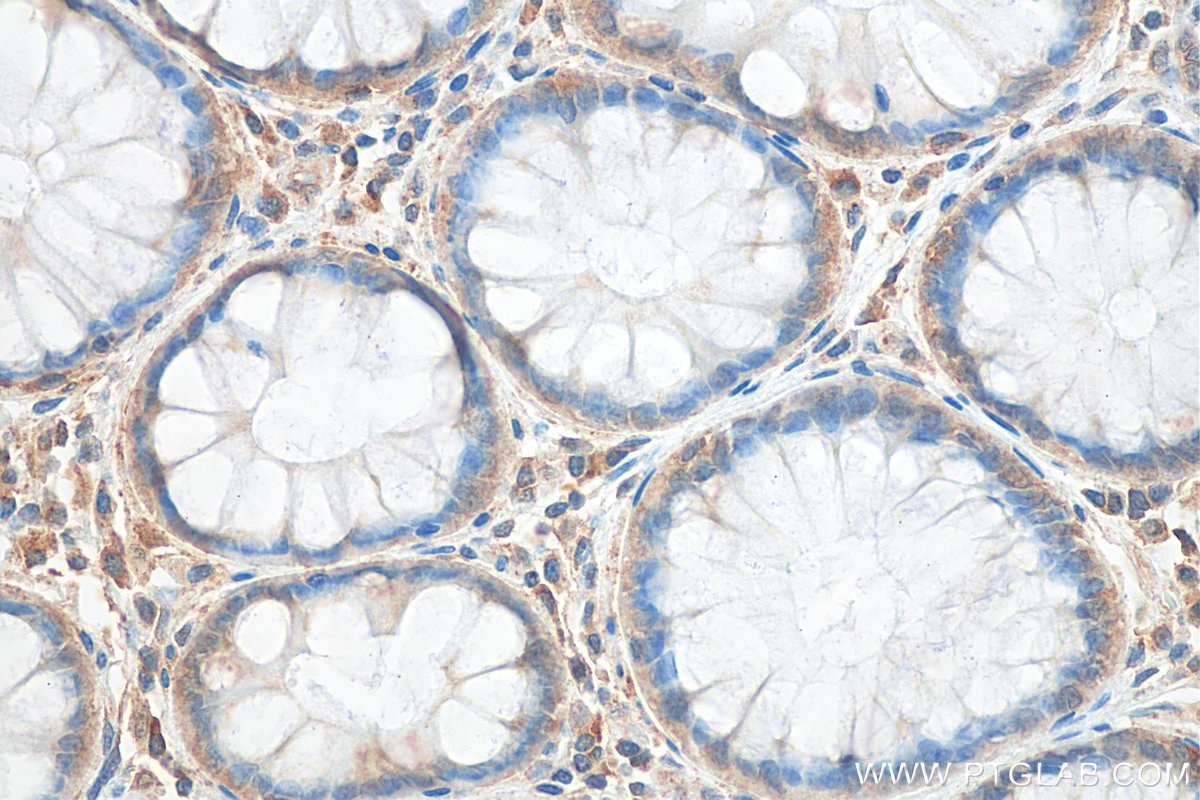 Immunohistochemistry (IHC) staining of human colon cancer tissue using Prokineticin 1 Polyclonal antibody (15152-1-AP)