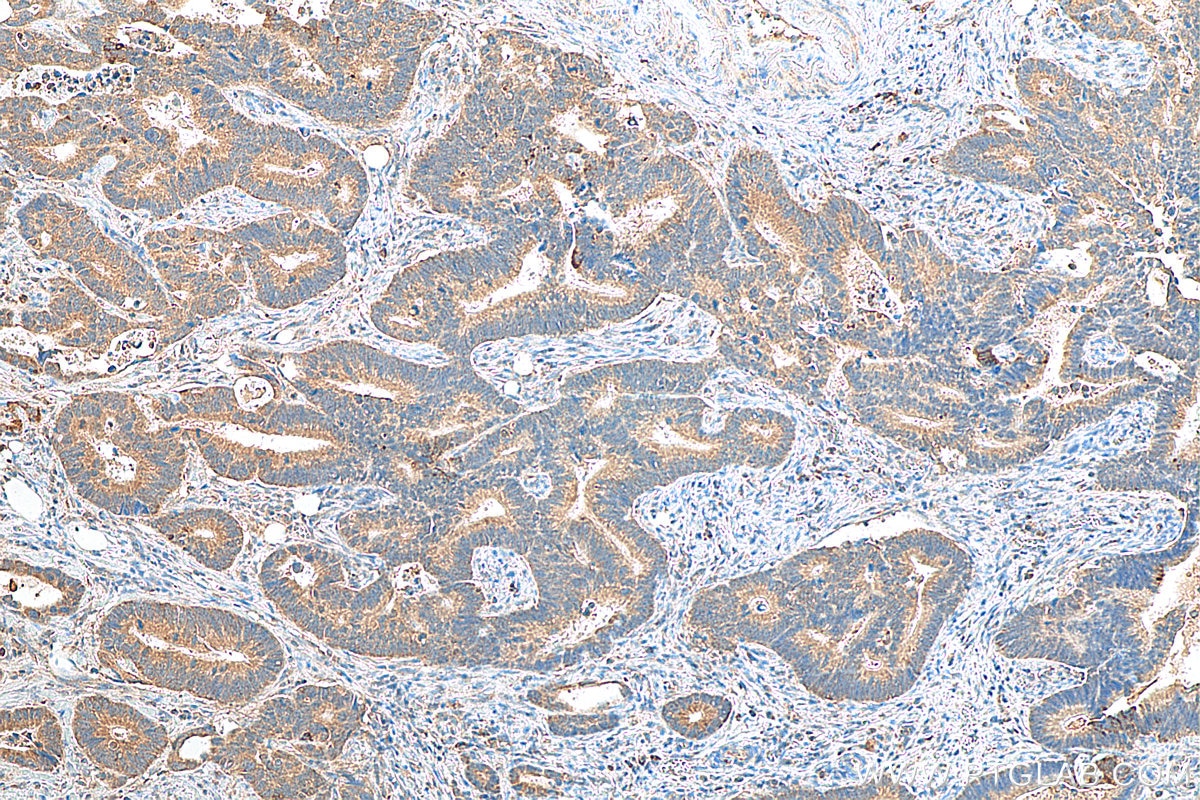 Immunohistochemistry (IHC) staining of human colon cancer tissue using Prokineticin 1 Polyclonal antibody (15152-1-AP)