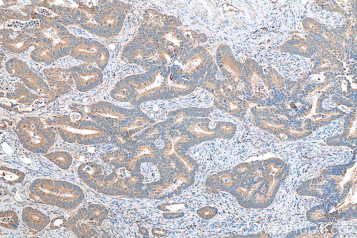 IHC staining of human colon cancer using 15152-1-AP