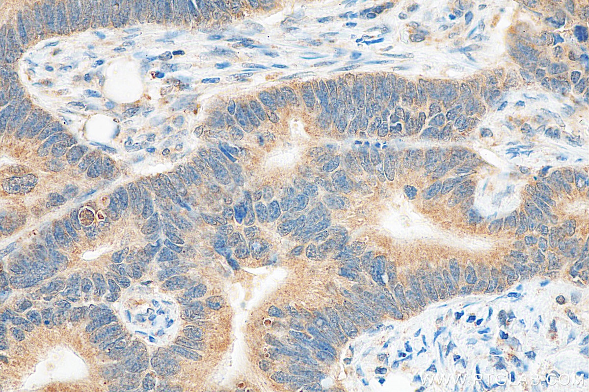 Immunohistochemistry (IHC) staining of human colon cancer tissue using Prokineticin 1 Polyclonal antibody (15152-1-AP)