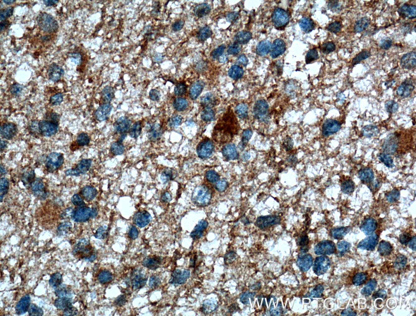 Immunohistochemistry (IHC) staining of human gliomas tissue using CD133-1,2,4,7 Polyclonal antibody (19945-1-AP)