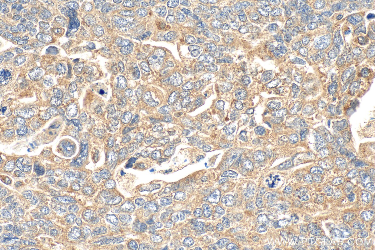 IHC staining of human ovary tumor using 31494-1-AP Immunohistochemistry (IHC) staining of human ovary tumor tissue using PROSER1 Polyclonal antibody (31494-1-AP)