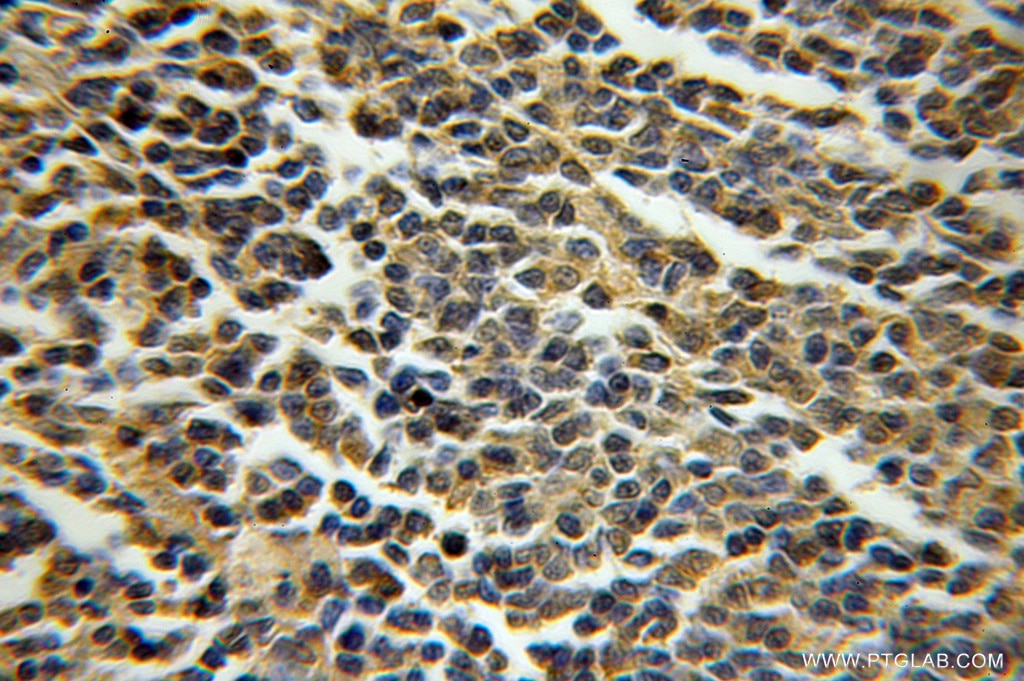 Immunohistochemistry (IHC) staining of human lymphoma tissue using PROX1 Polyclonal antibody (51043-1-AP)