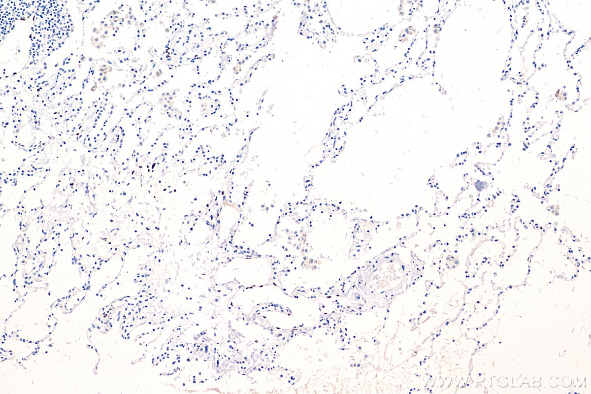 Immunohistochemistry (IHC) staining of human lung cancer tissue using PROX1 Monoclonal antibody (67438-1-Ig)