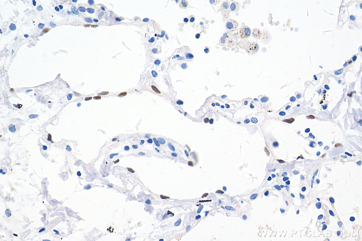 Immunohistochemistry (IHC) staining of human lung cancer tissue using PROX1 Monoclonal antibody (67438-1-Ig)