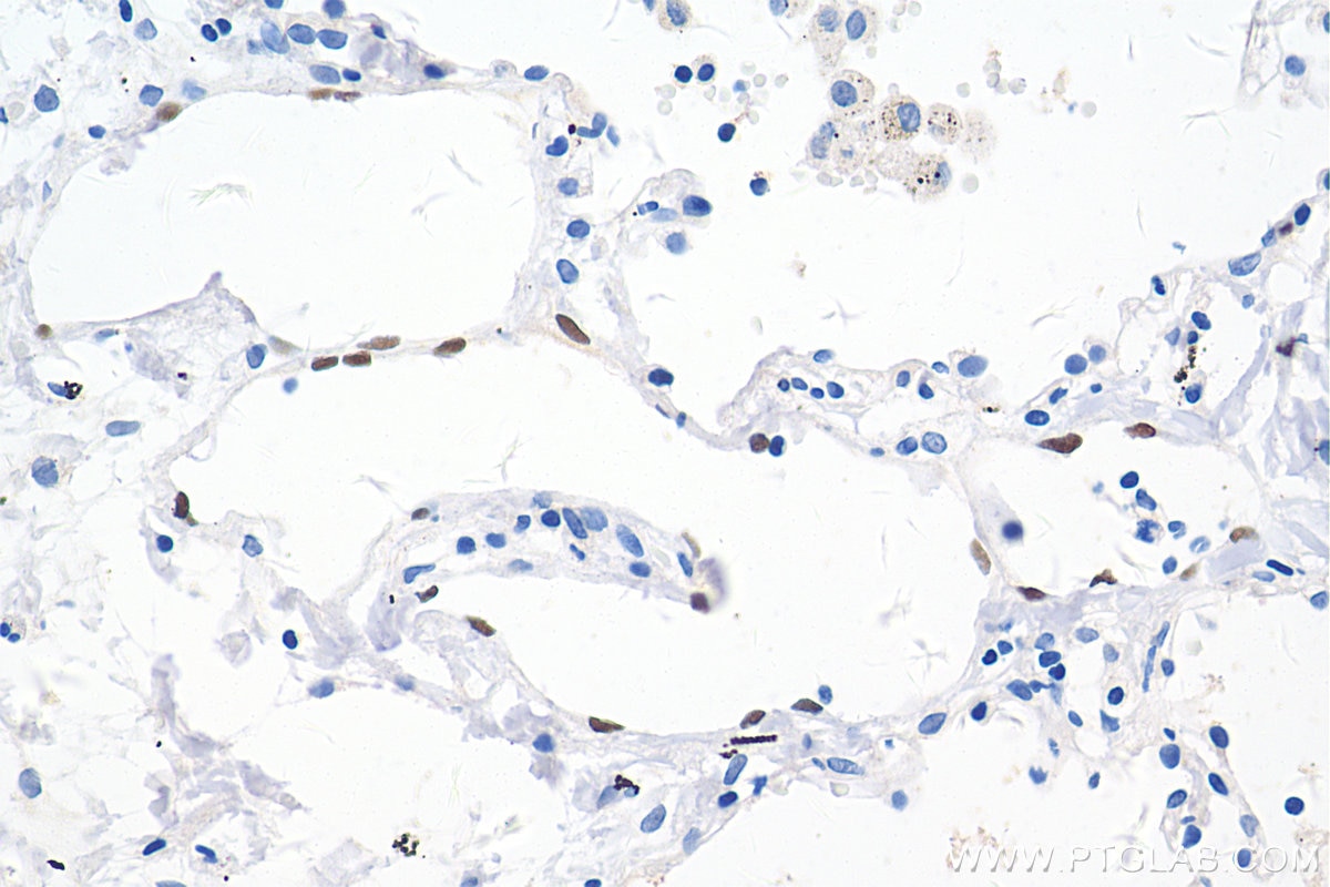 IHC staining of human lung cancer using 67438-1-Ig