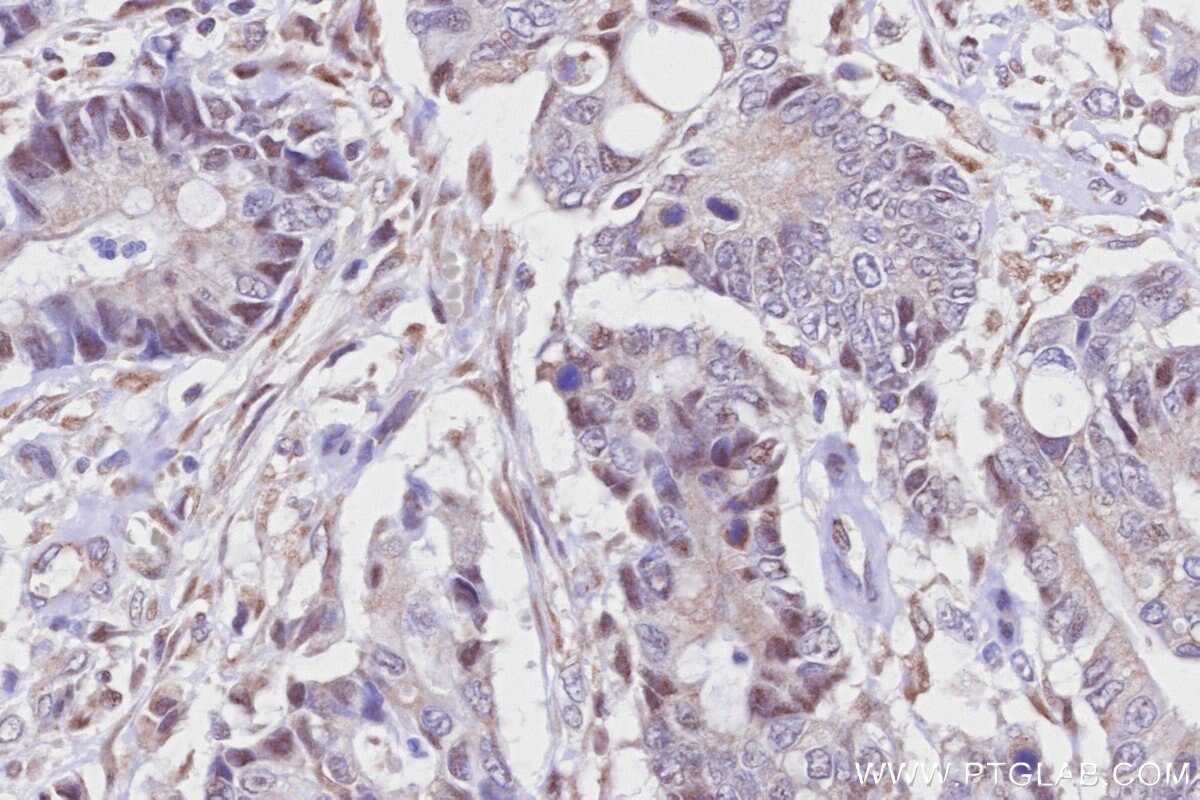 Immunohistochemistry (IHC) staining of human rectal cancer tissue using PROX1 Recombinant monoclonal antibody (81778-1-RR)