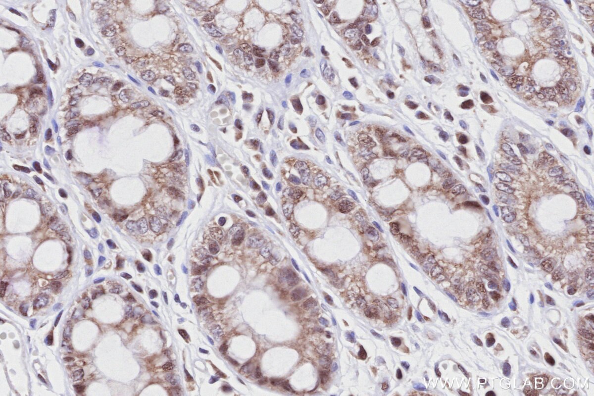Immunohistochemistry (IHC) staining of human rectal cancer tissue using PROX1 Recombinant monoclonal antibody (81778-1-RR)