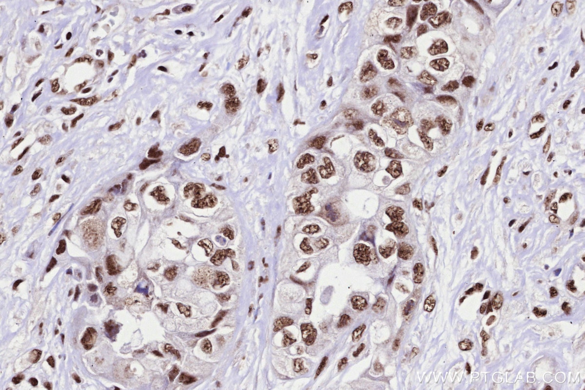 Immunohistochemistry (IHC) staining of human pancreas cancer tissue using PRPF31 Recombinant monoclonal antibody (86315-1-RR)