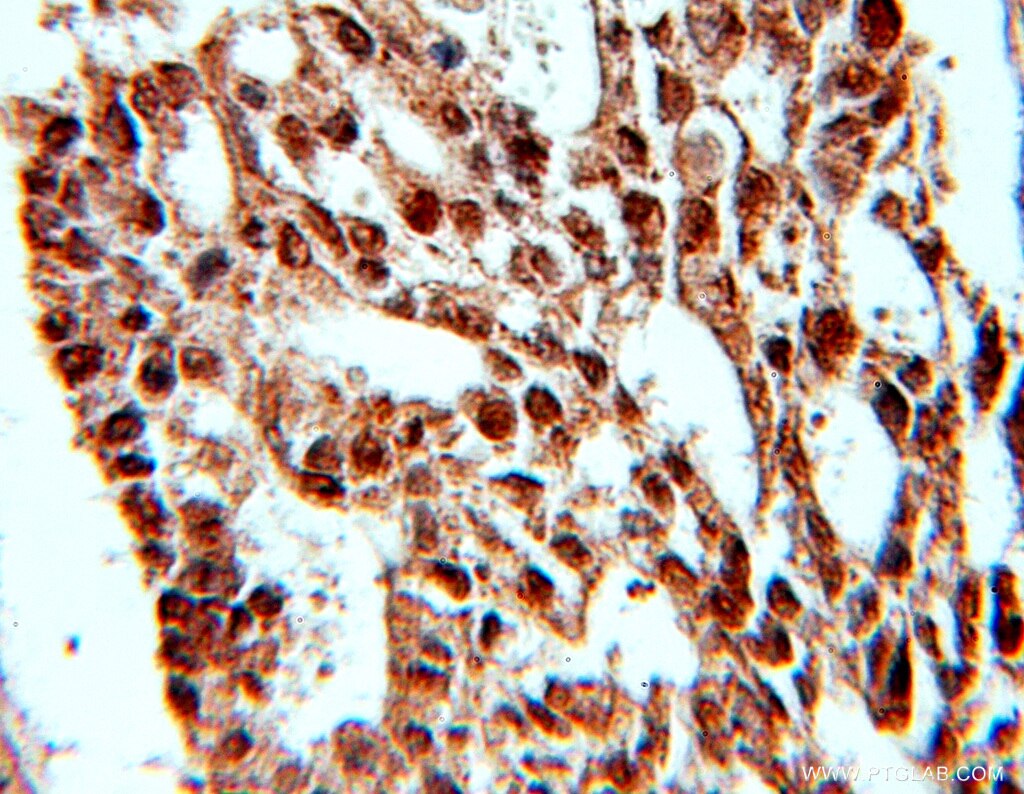 Immunohistochemistry (IHC) staining of human ovary tumor tissue using PRPF4 Polyclonal antibody (10728-1-AP)