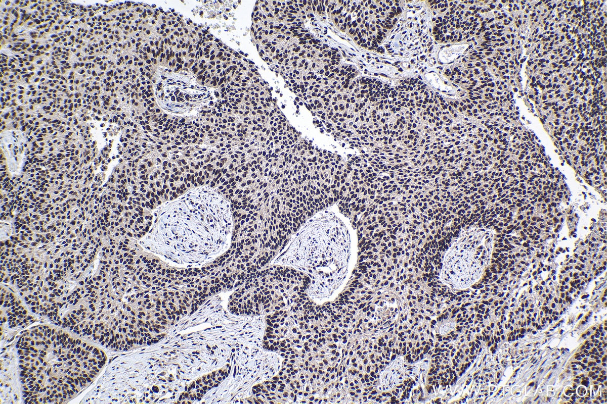 Immunohistochemical analysis of paraffin-embedded human lung cancer tissue slide using 17392-1-AP (PRPF40A antibody) at dilution of 1:500 (under 10x lens). Heat mediated antigen retrieval with Tris-EDTA buffer (pH 9.0). Immunohistochemistry (IHC) staining of human lung cancer tissue using PRPF40A Polyclonal antibody (17392-1-AP)