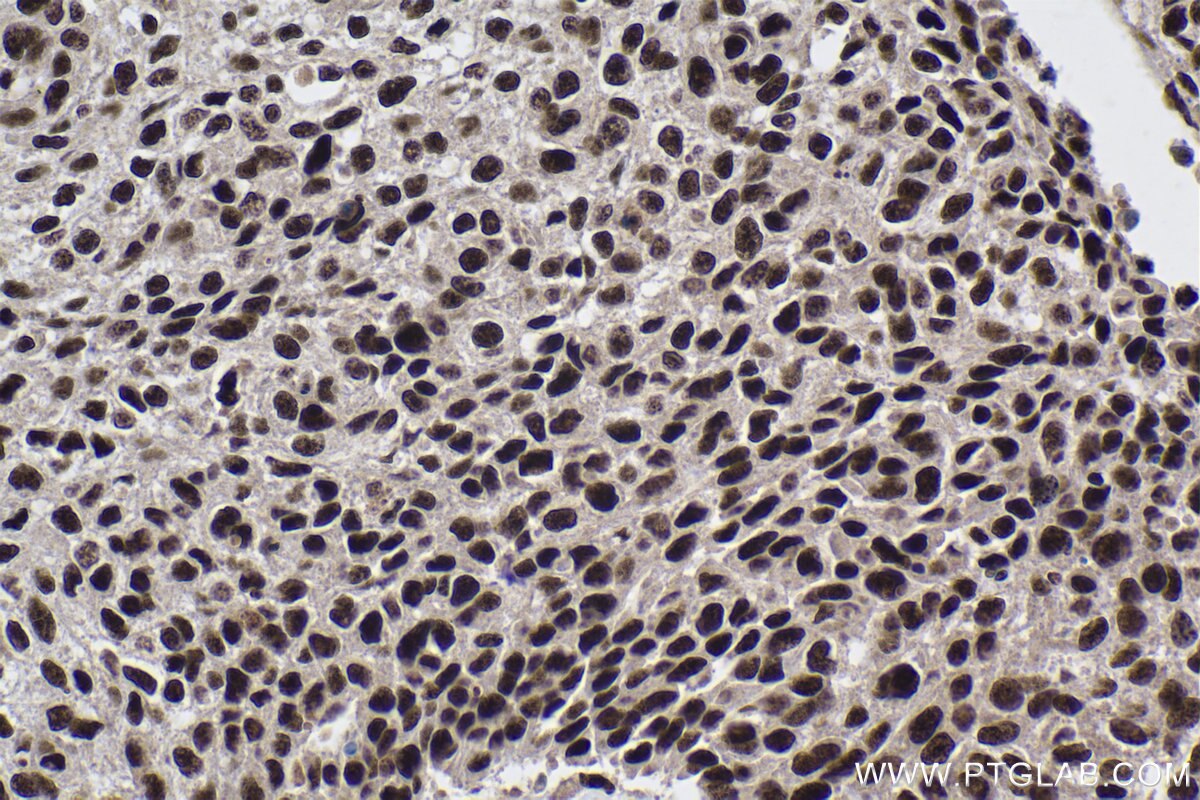 Immunohistochemical analysis of paraffin-embedded human lung cancer tissue slide using 17392-1-AP (PRPF40A antibody) at dilution of 1:500 (under 40x lens). Heat mediated antigen retrieval with Tris-EDTA buffer (pH 9.0). Immunohistochemistry (IHC) staining of human lung cancer tissue using PRPF40A Polyclonal antibody (17392-1-AP)