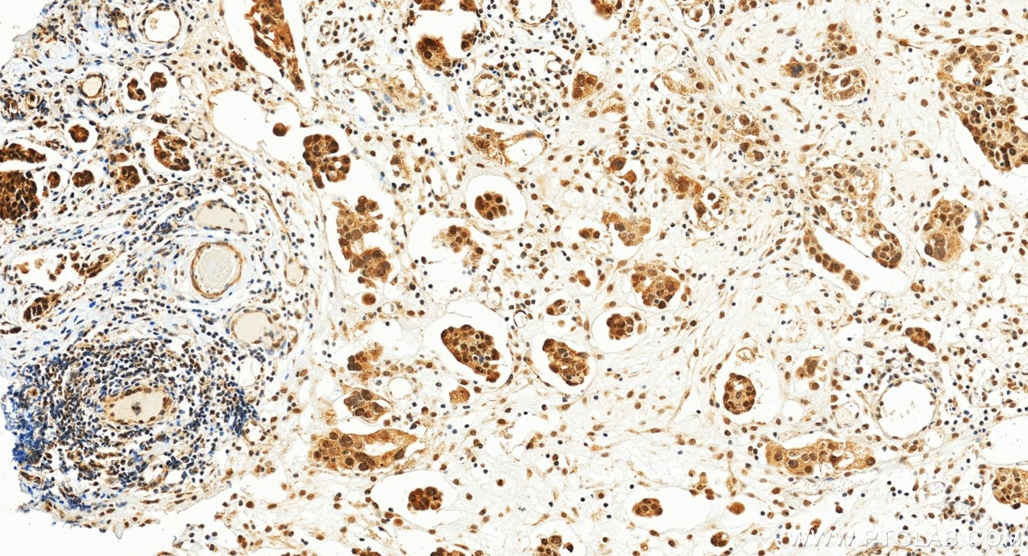 Immunohistochemistry (IHC) staining of human ovary tumor tissue using PRPF8 Polyclonal antibody (11171-1-AP)