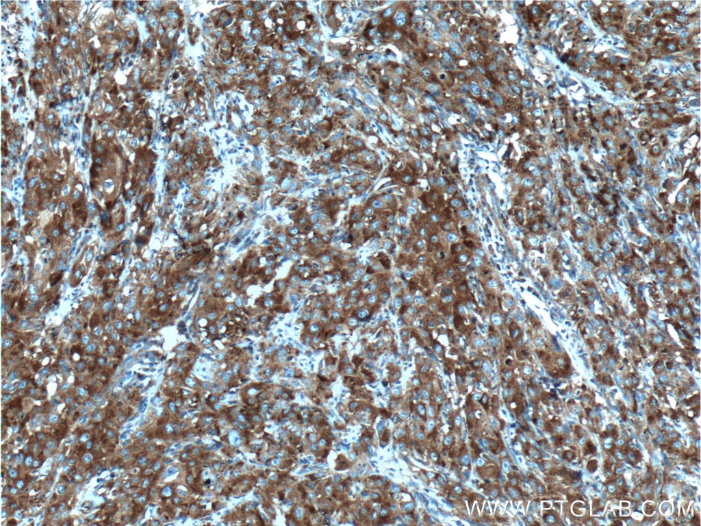 Immunohistochemistry (IHC) staining of human cervical cancer tissue using PRPSAP1 Polyclonal antibody (16790-1-AP)
