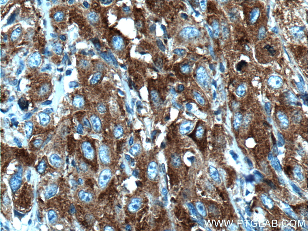 Immunohistochemistry (IHC) staining of human cervical cancer tissue using PRPSAP1 Polyclonal antibody (16790-1-AP)