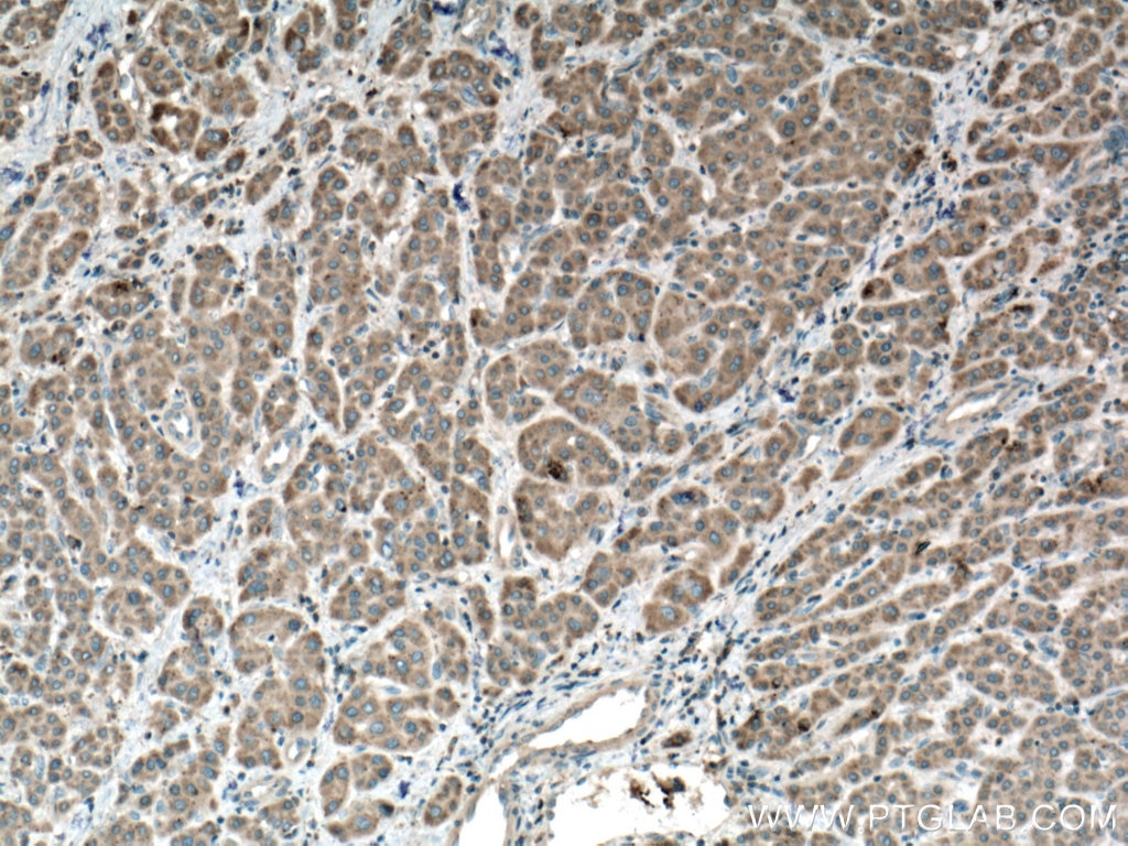 Immunohistochemistry (IHC) staining of human liver cancer tissue using PRPSAP1 Polyclonal antibody (16790-1-AP)