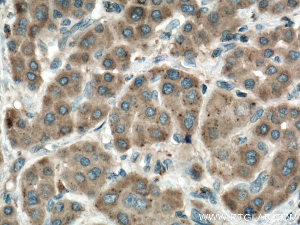 Immunohistochemistry (IHC) staining of human liver cancer tissue using PRPSAP1 Polyclonal antibody (16790-1-AP)