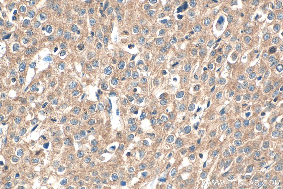 Immunohistochemical analysis of paraffin-embedded human cervical cancer tissue slide using 16790-1-AP (PRPSAP1 antibody) at dilution of 1:200 (under 40x lens). Heat mediated antigen retrieval with Tris-EDTA buffer (pH 9.0). Immunohistochemistry (IHC) staining of human cervical cancer tissue using PRPSAP1 Polyclonal antibody (16790-1-AP)