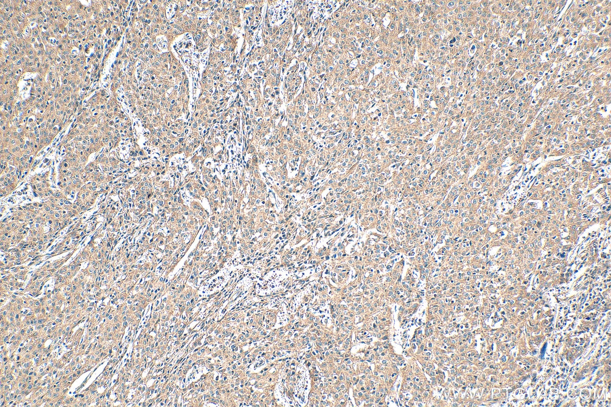 Immunohistochemical analysis of paraffin-embedded human cervical cancer tissue slide using 16790-1-AP (PRPSAP1 antibody) at dilution of 1:200 (under 10x lens). Heat mediated antigen retrieval with Tris-EDTA buffer (pH 9.0). Immunohistochemistry (IHC) staining of human cervical cancer tissue using PRPSAP1 Polyclonal antibody (16790-1-AP)