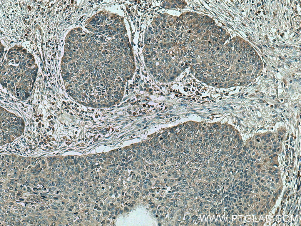 IHC staining of human oesophagus cancer using 19515-1-AP