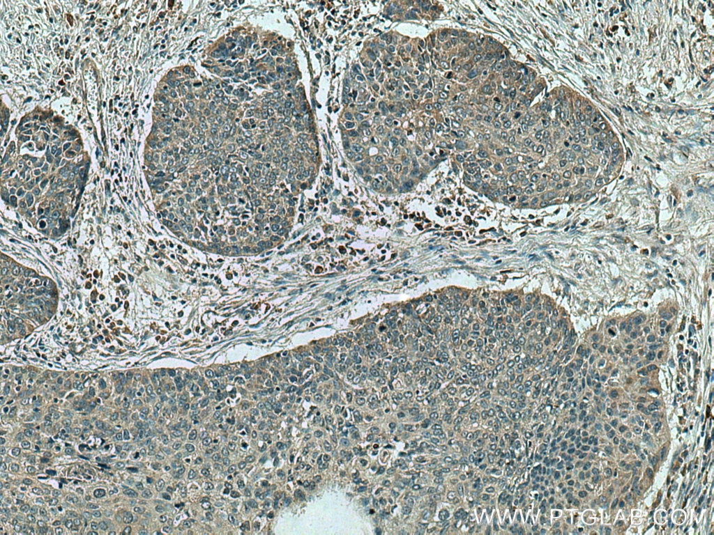 Immunohistochemistry (IHC) staining of human oesophagus cancer tissue using PRSS27 Polyclonal antibody (19515-1-AP)