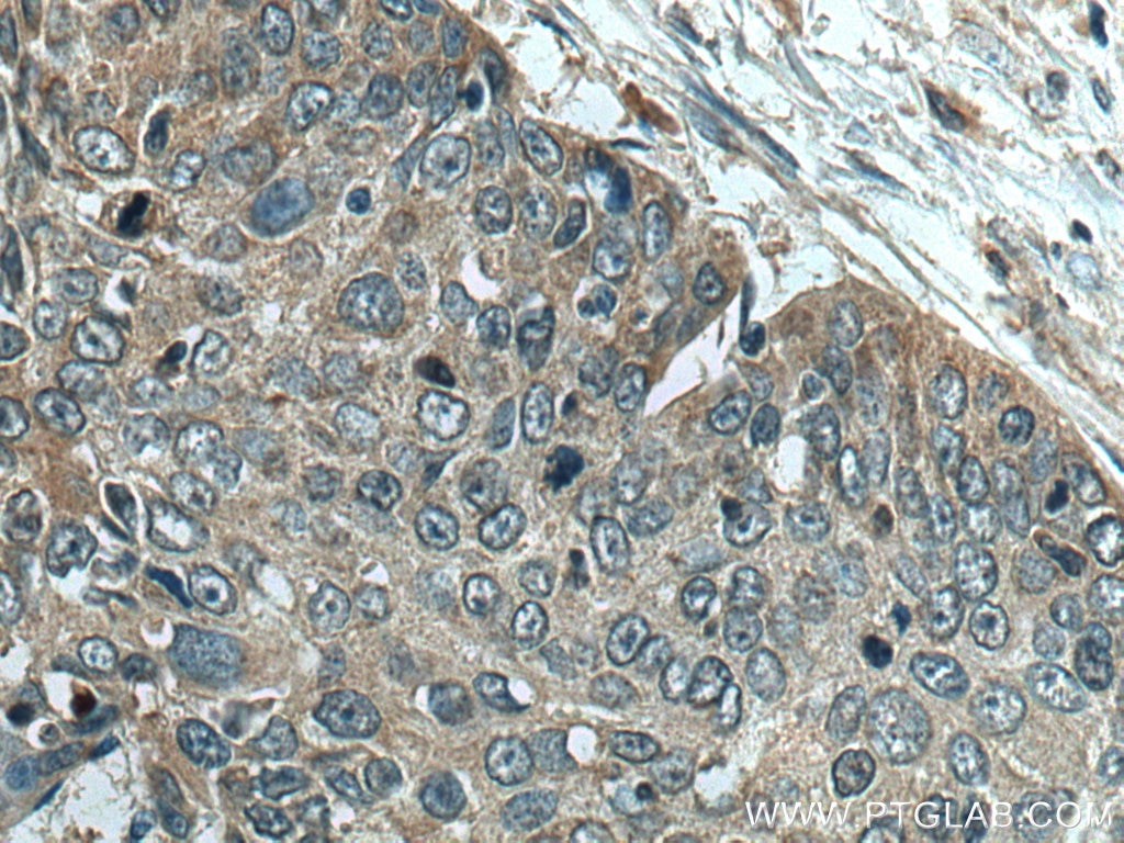 Immunohistochemistry (IHC) staining of human oesophagus cancer tissue using PRSS27 Polyclonal antibody (19515-1-AP)