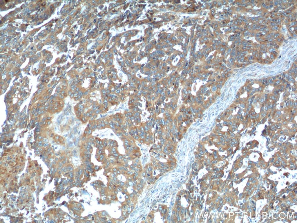 Immunohistochemistry (IHC) staining of human ovary tumor tissue using PRSS8 Polyclonal antibody (15527-1-AP)