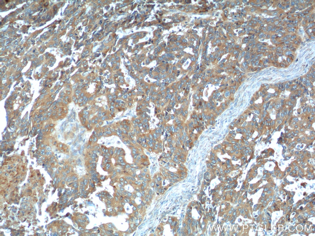 IHC staining of human ovary tumor using 15527-1-AP