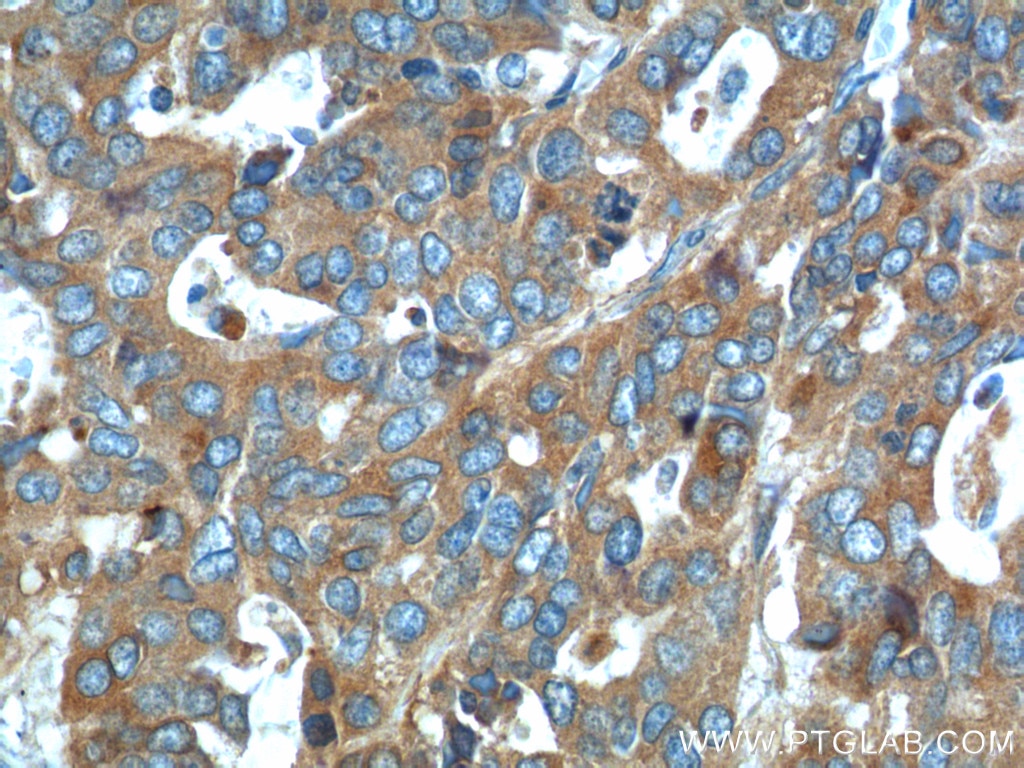 Immunohistochemistry (IHC) staining of human ovary tumor tissue using PRSS8 Polyclonal antibody (15527-1-AP)