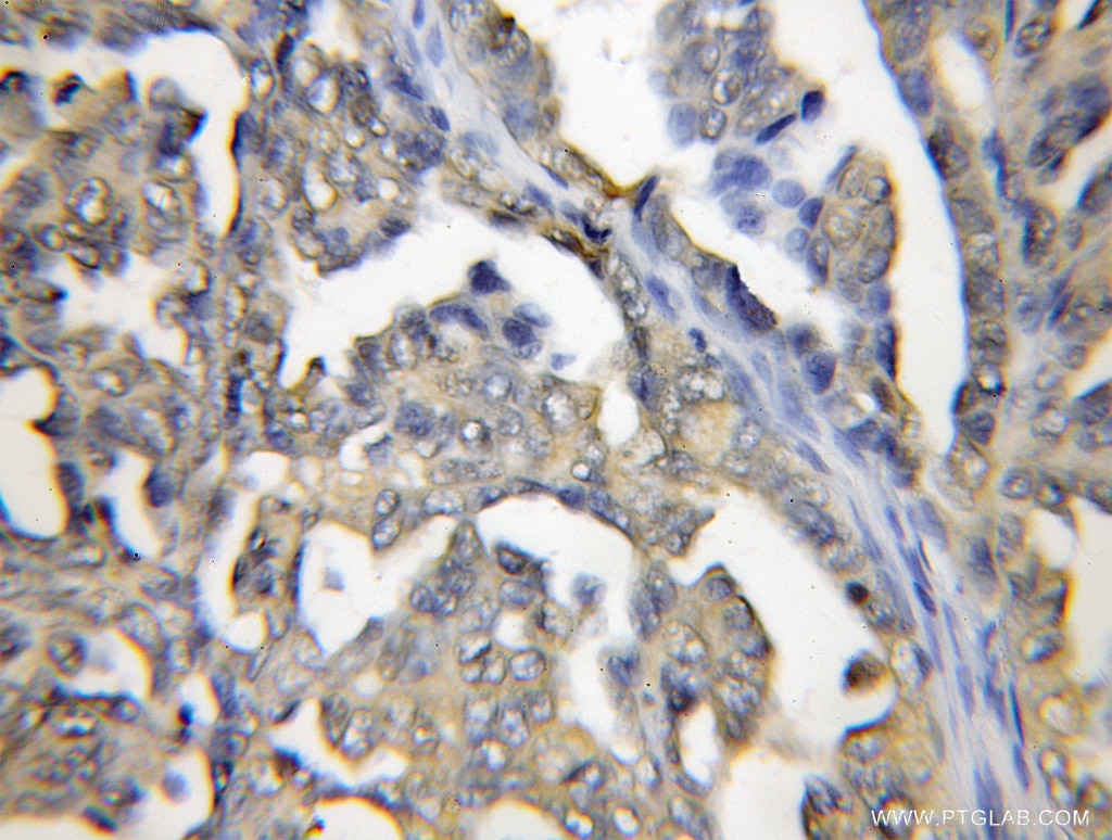 Immunohistochemistry (IHC) staining of human ovary tumor tissue using PRTFDC1 Polyclonal antibody (11986-1-AP)