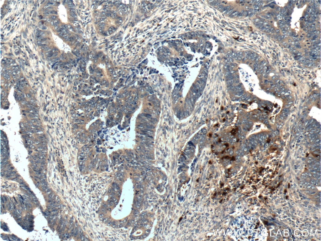 Immunohistochemistry (IHC) staining of human colon cancer tissue using PRTN3 Polyclonal antibody (25278-1-AP)