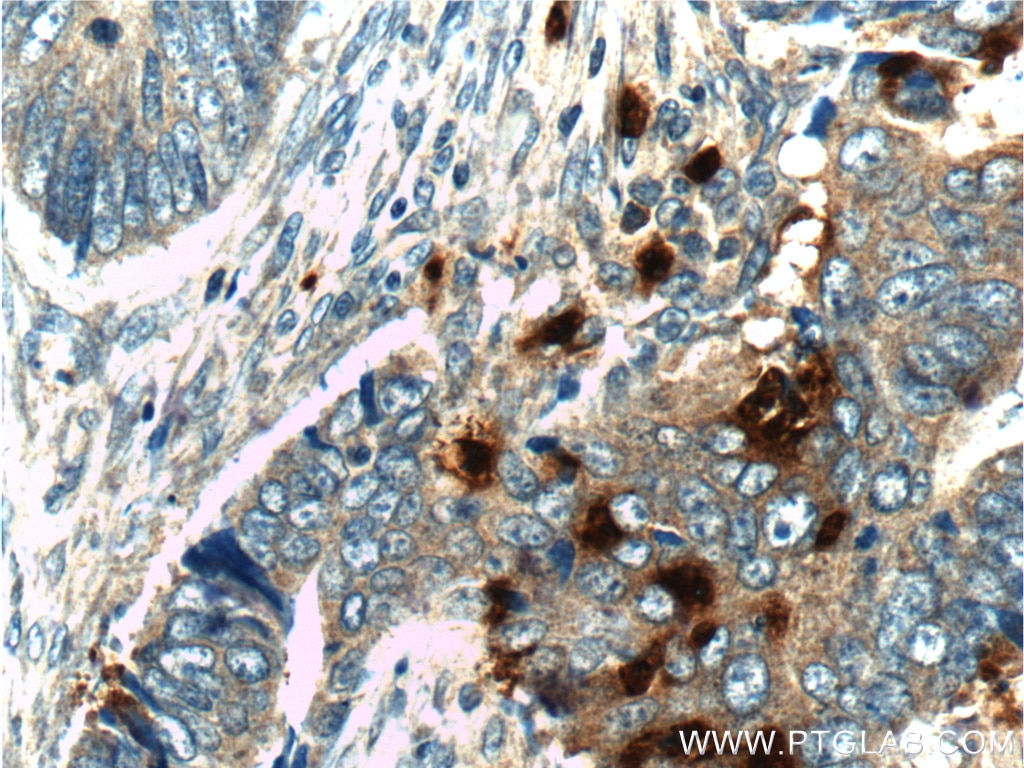 Immunohistochemistry (IHC) staining of human colon cancer tissue using PRTN3 Polyclonal antibody (25278-1-AP)
