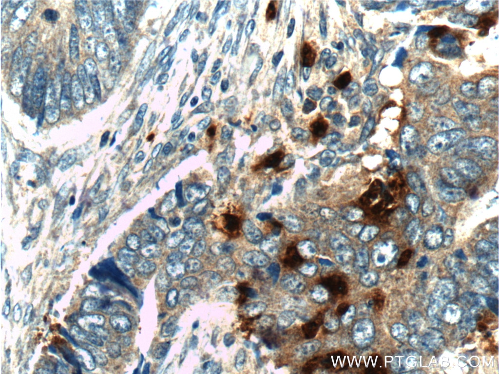 IHC staining of human colon cancer using 25278-1-AP