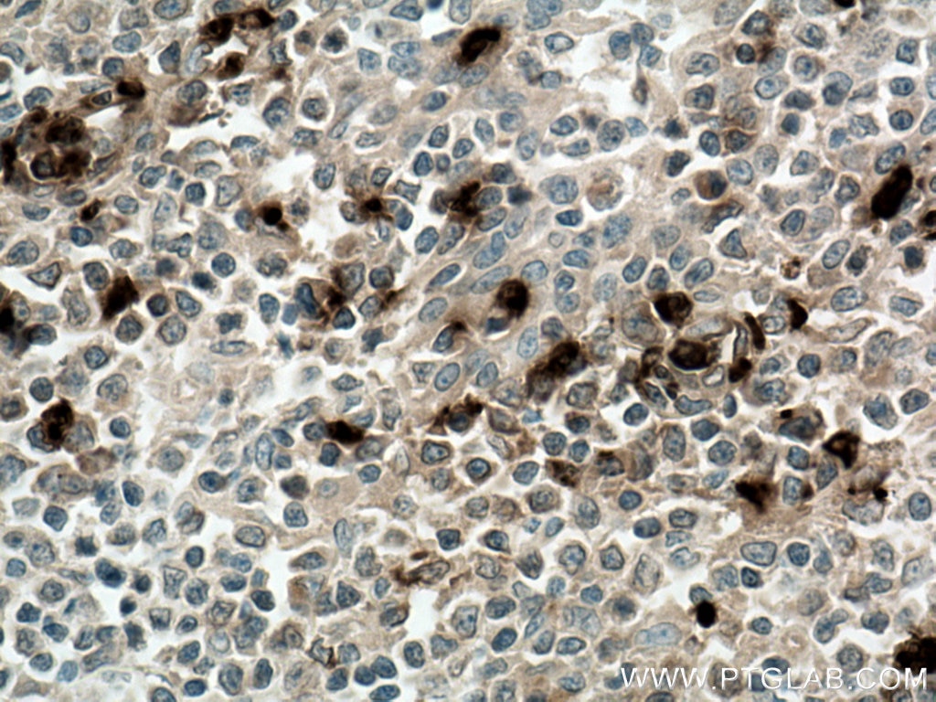 Immunohistochemistry (IHC) staining of human tonsillitis tissue using PRTN3 Polyclonal antibody (27153-1-AP)