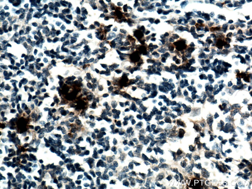 Immunohistochemistry (IHC) staining of human tonsillitis tissue using PRTN3 Monoclonal antibody (67030-1-Ig)