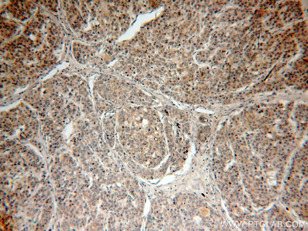 Immunohistochemistry (IHC) staining of human liver cancer tissue using PRUNE Polyclonal antibody (18537-1-AP)