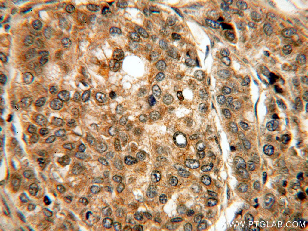 Immunohistochemistry (IHC) staining of human liver cancer tissue using PRUNE Polyclonal antibody (18537-1-AP)