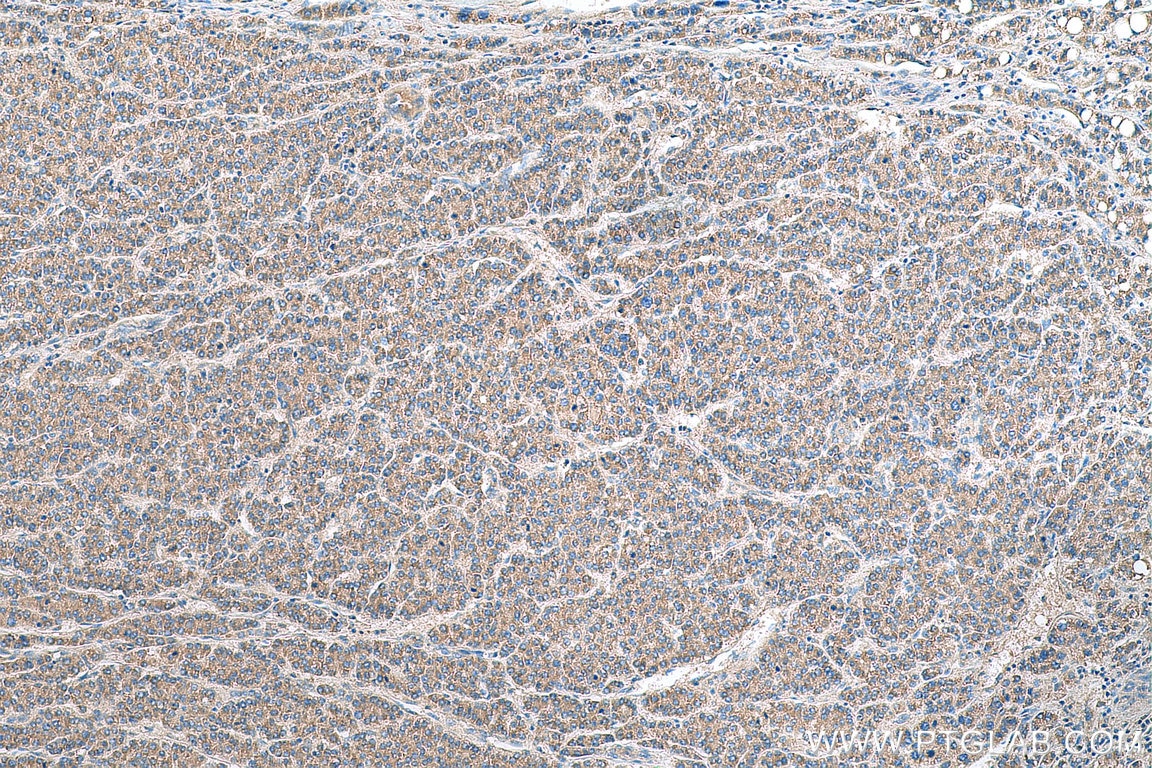 Immunohistochemistry (IHC) staining of human liver cancer tissue using PRUNE2 Polyclonal antibody (11458-1-AP)