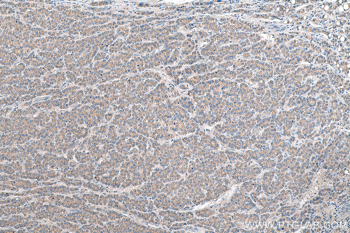 IHC staining of human liver cancer using 11458-1-AP