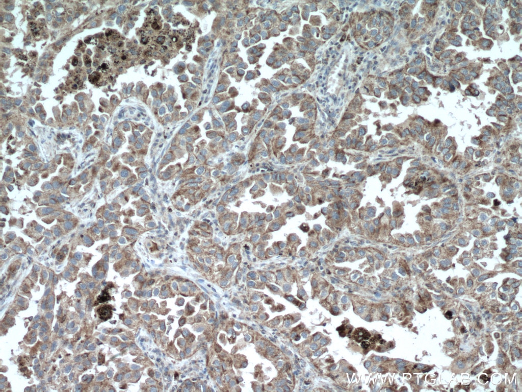 Immunohistochemistry (IHC) staining of human lung cancer tissue using PRDX3 Polyclonal antibody (10664-1-AP)