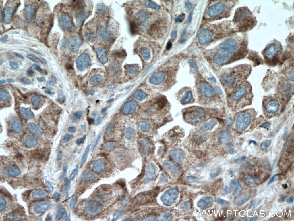 Immunohistochemistry (IHC) staining of human lung cancer tissue using PRDX3 Polyclonal antibody (10664-1-AP)