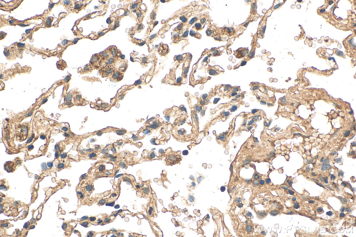 Immunohistochemistry (IHC) staining of human lung cancer tissue using PRDX3 Recombinant antibody (81833-1-RR)