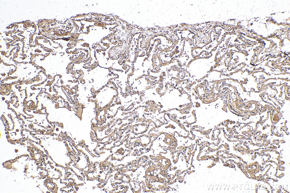 Immunohistochemistry (IHC) staining of human lung cancer tissue using PRDX3 Recombinant antibody (81833-1-RR)