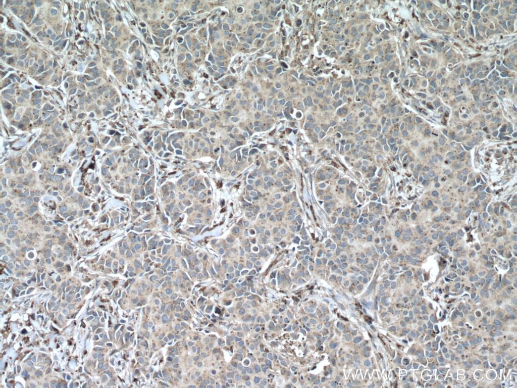 IHC staining of human breast cancer using 10801-1-AP