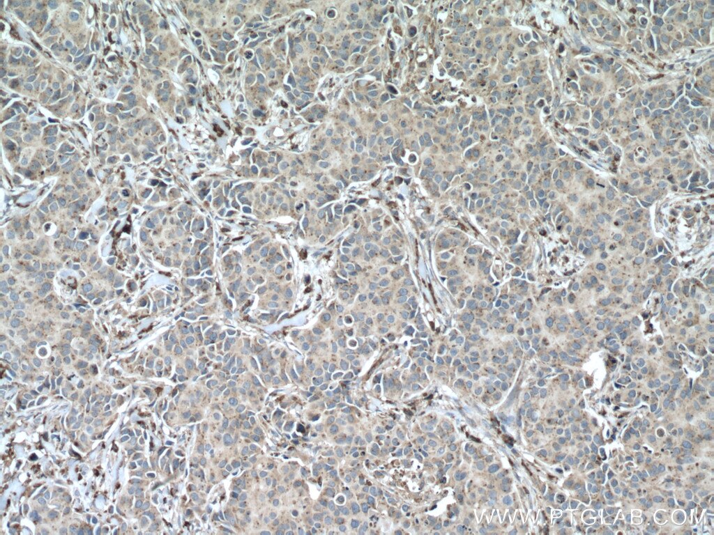 Immunohistochemistry (IHC) staining of human breast cancer tissue using PSAP Polyclonal antibody (10801-1-AP)