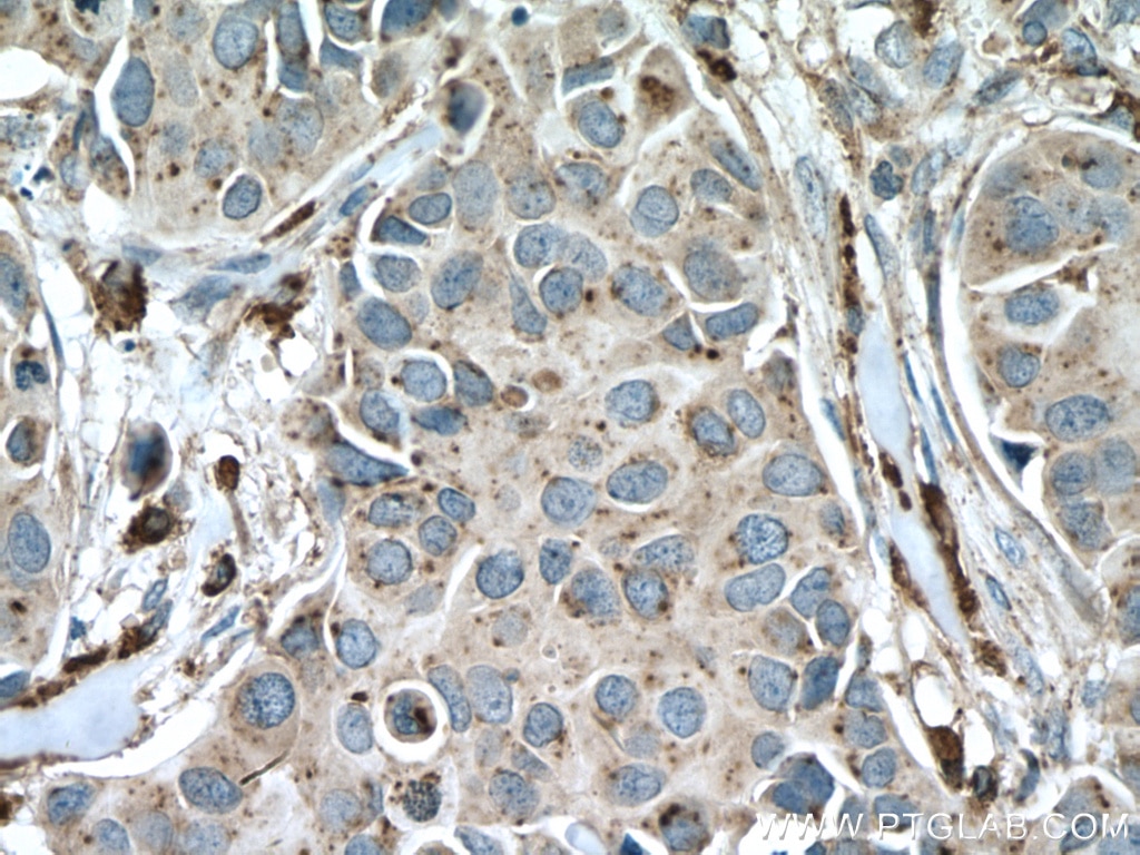 Immunohistochemistry (IHC) staining of human breast cancer tissue using PSAP Polyclonal antibody (10801-1-AP)
