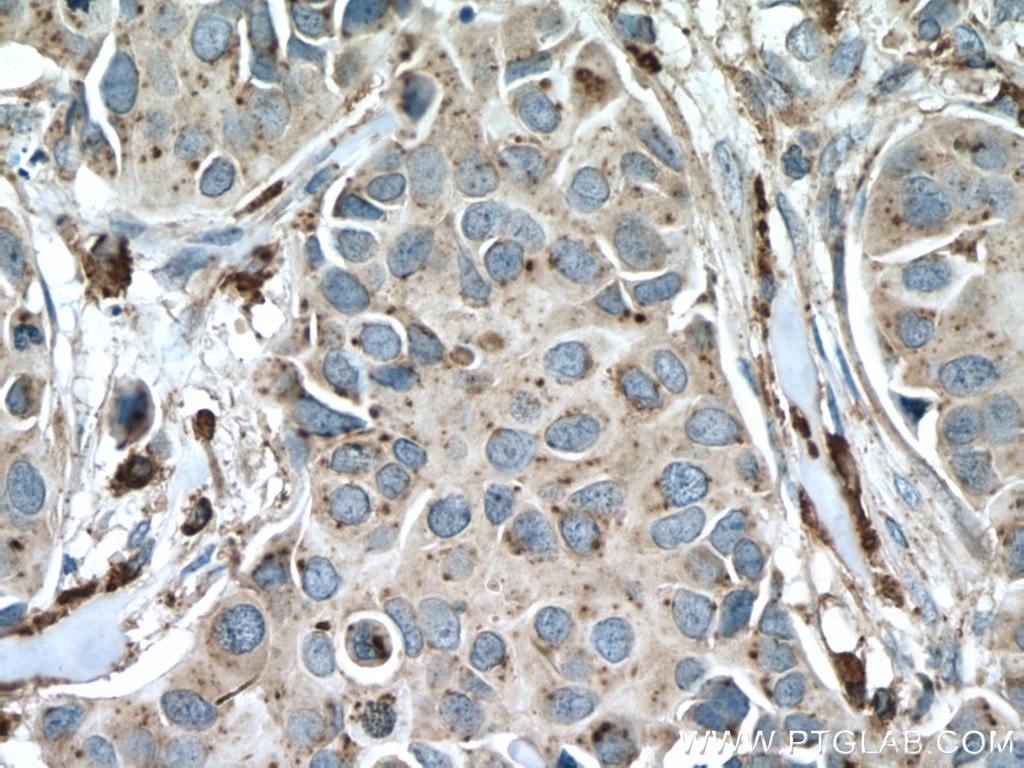 IHC staining of human breast cancer using 10801-1-AP