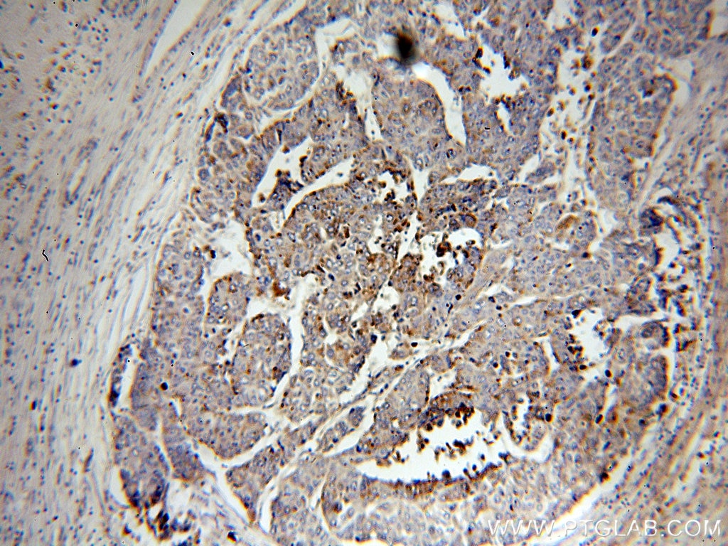 Immunohistochemistry (IHC) staining of human liver cancer tissue using PSAP Polyclonal antibody (18396-1-AP)